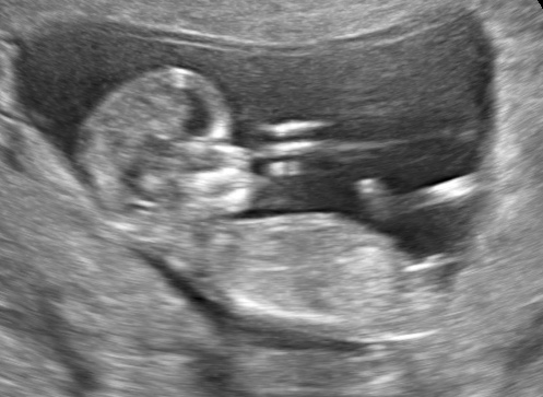 Een echo na 12 weken.