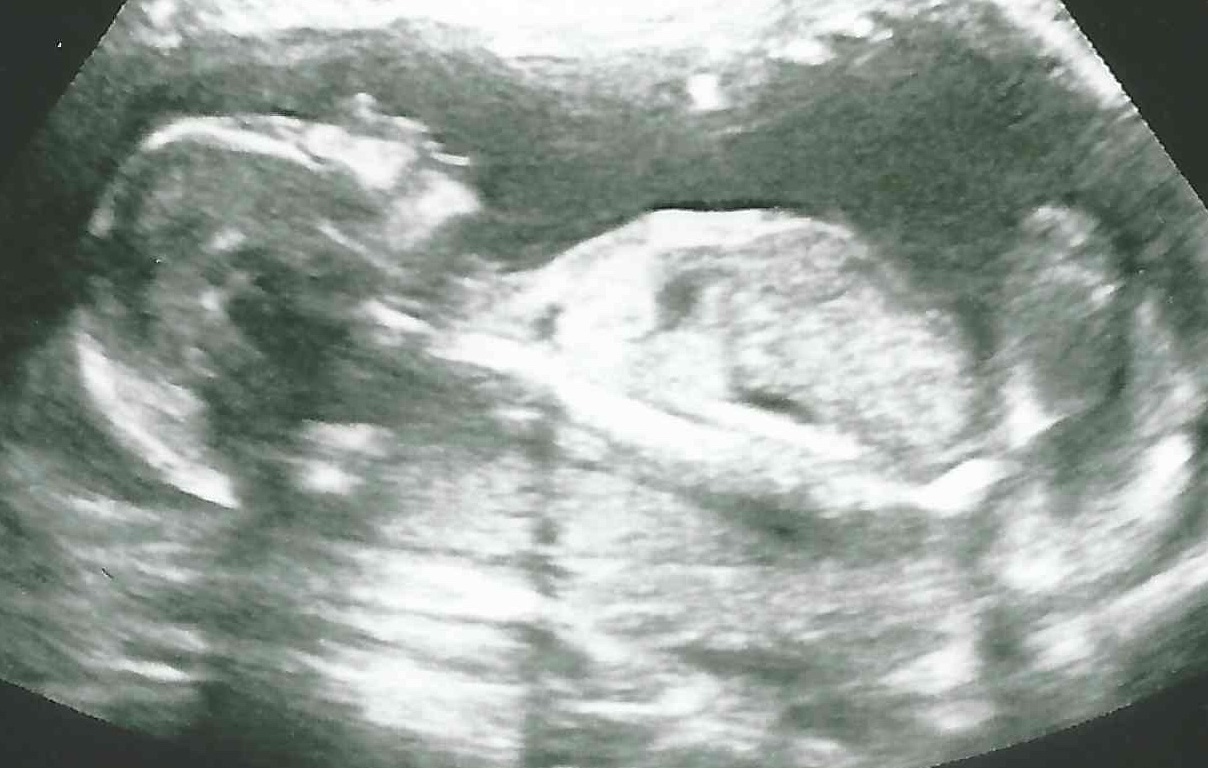 Een echo na 16 weken.