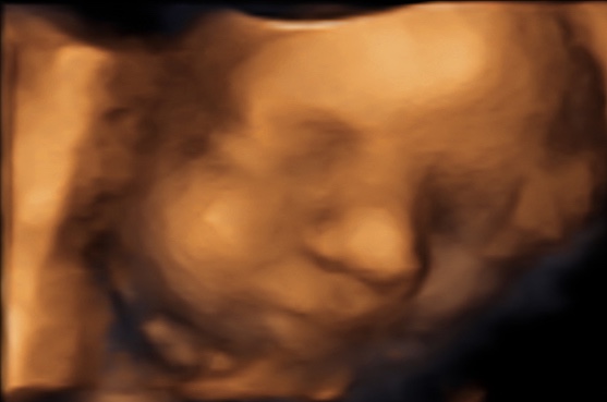 Een echo na 34 weken.